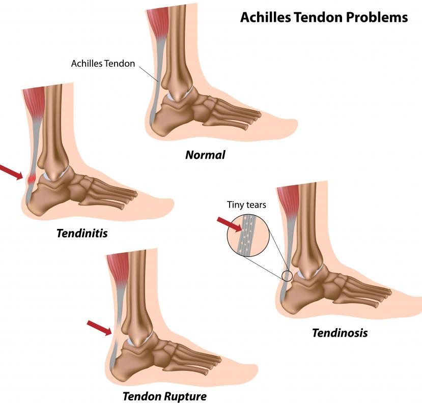 Flexibility training can help stretch the tendons, which may prevent many of these common Achilles tendon problems.