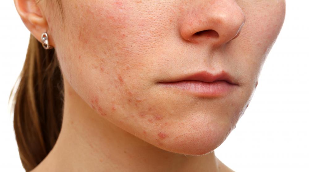 In Hawaii, kukui nut oil is sometimes used to treat acne.