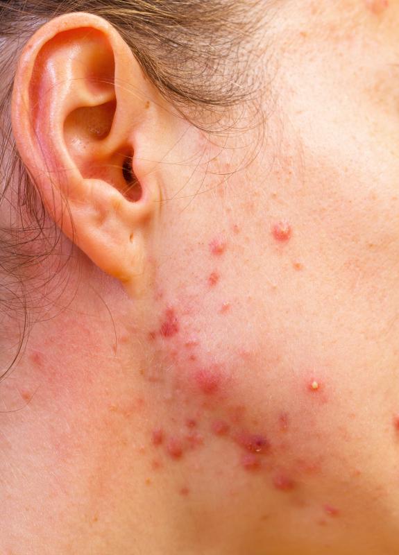 Vitex side effects may include acne.