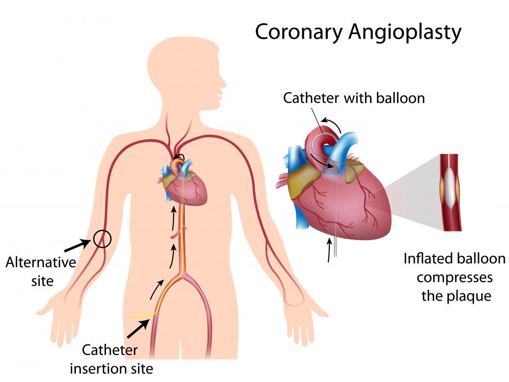 Most cardiac catheters are inserted in the upper part of the femoral artery, including those used in coronary angioplasties.