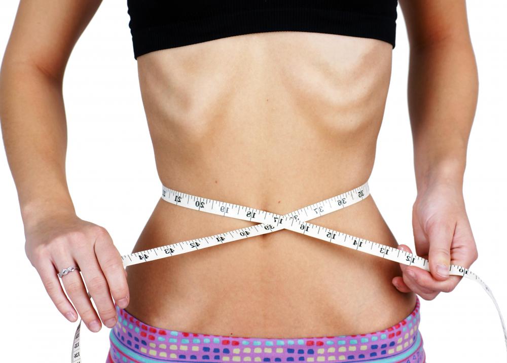 Anorexia nervosa is associated with pili torti.