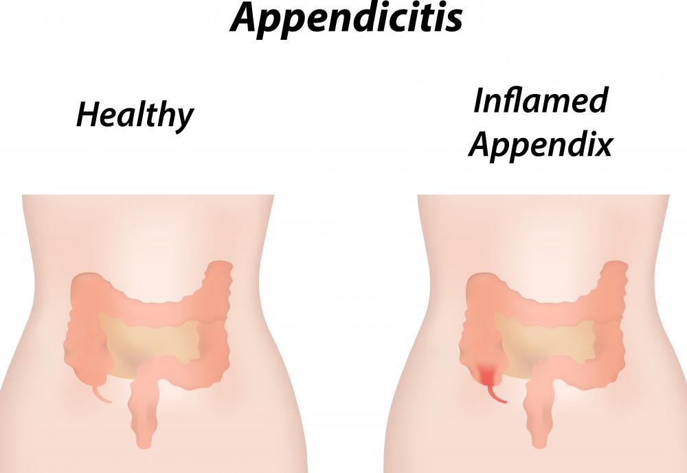 Appendicitis can be the cause of a perforated colon.
