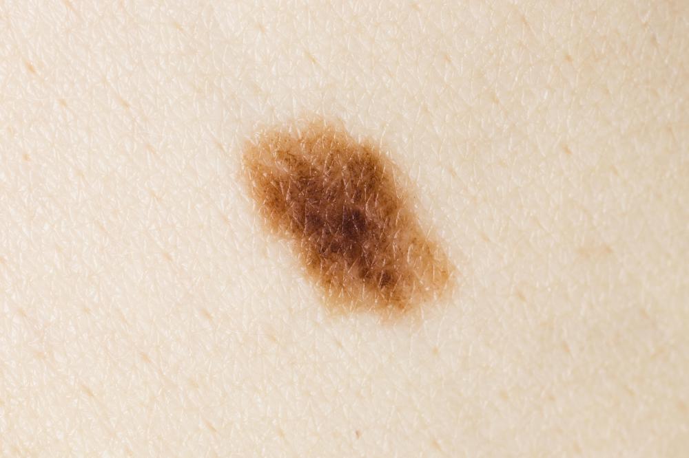 An asymmetrical mole with blurred edges.