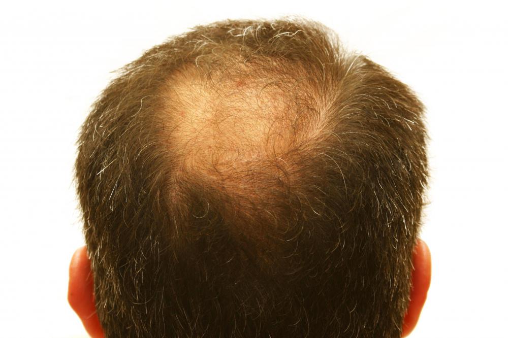 Hair loss is a possible side effect of extended pregnenolone use.