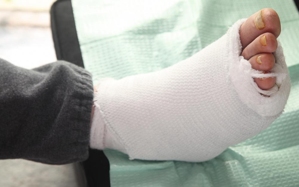 Blood clots may obstruct the flow of blood to limbs resulting in tissue damage to the affected area.