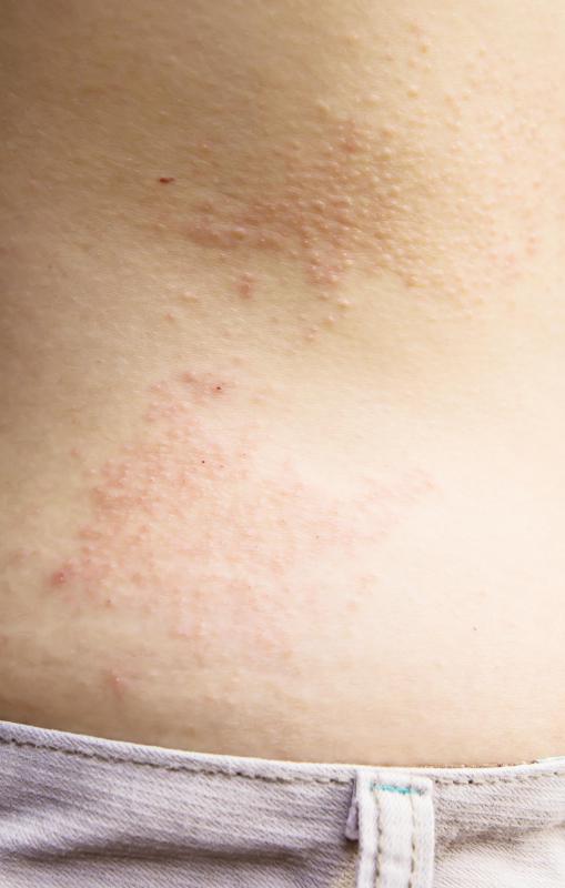 Belt buckle rash is a condition where the skin reacts to the metals in a belt buckle by breaking out into a rash.