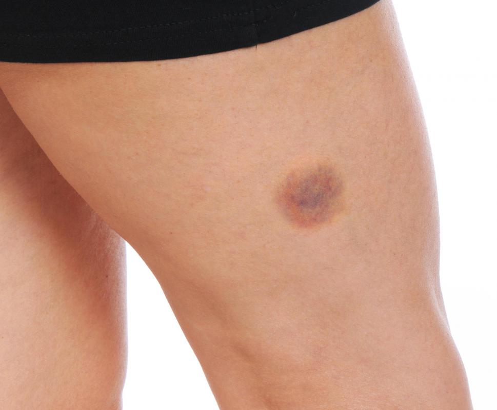 Unusual bruising can be cause by hormonal fluctuations that occur during pregnancy or after menopause.