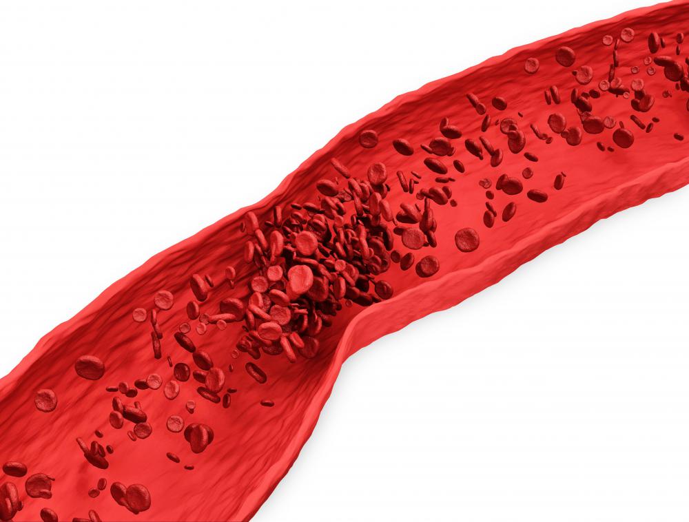 Saddle embolisms occur when blood clots blocks both sides of an arterial branch.