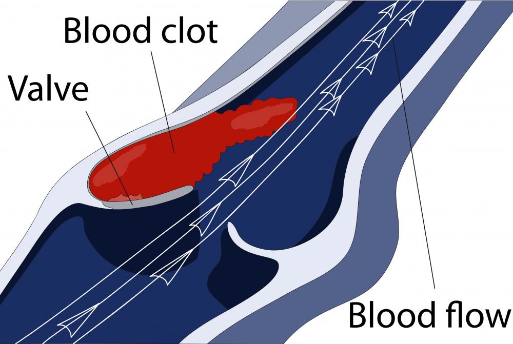 Doctors may request a plasma transfusion before, during, and after surgery to help the patient's blood clot more quickly.