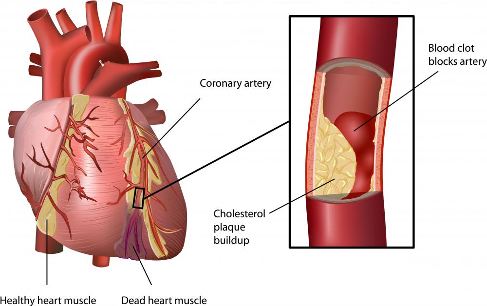 Blockage caused by blood clots may cause hypoxia.