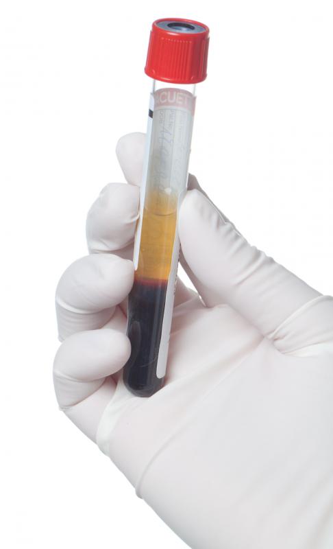 In many regions it is required by law to perform a blood test for the Australia antigen.