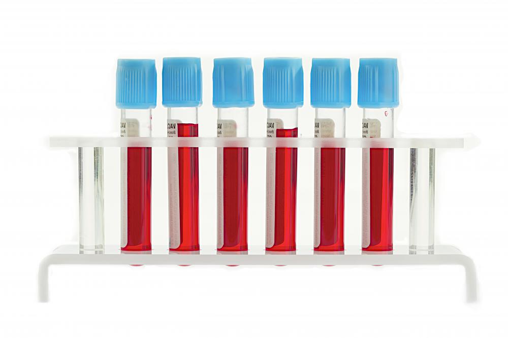 A lipid profile is a type of blood test.