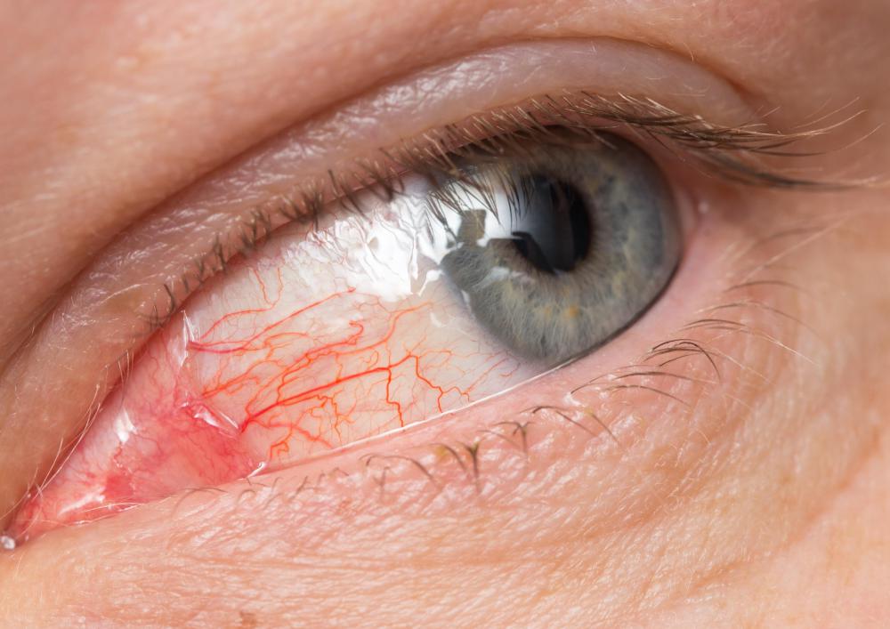 When the maxillary sinus is affected by a fracture of the lamina papyracea, it can increase the chance of infection entering and spreading throughout the eyes.