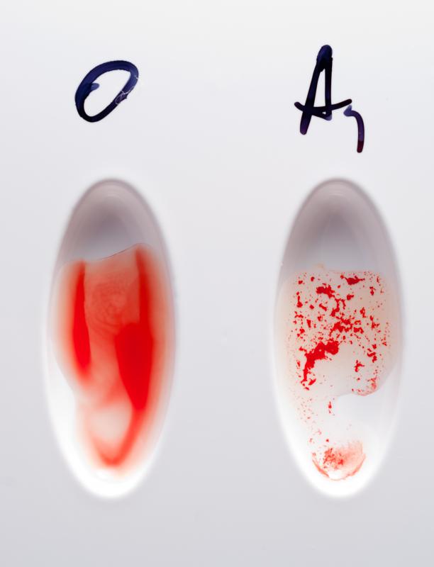 Two types of blood on a blood typing test card.