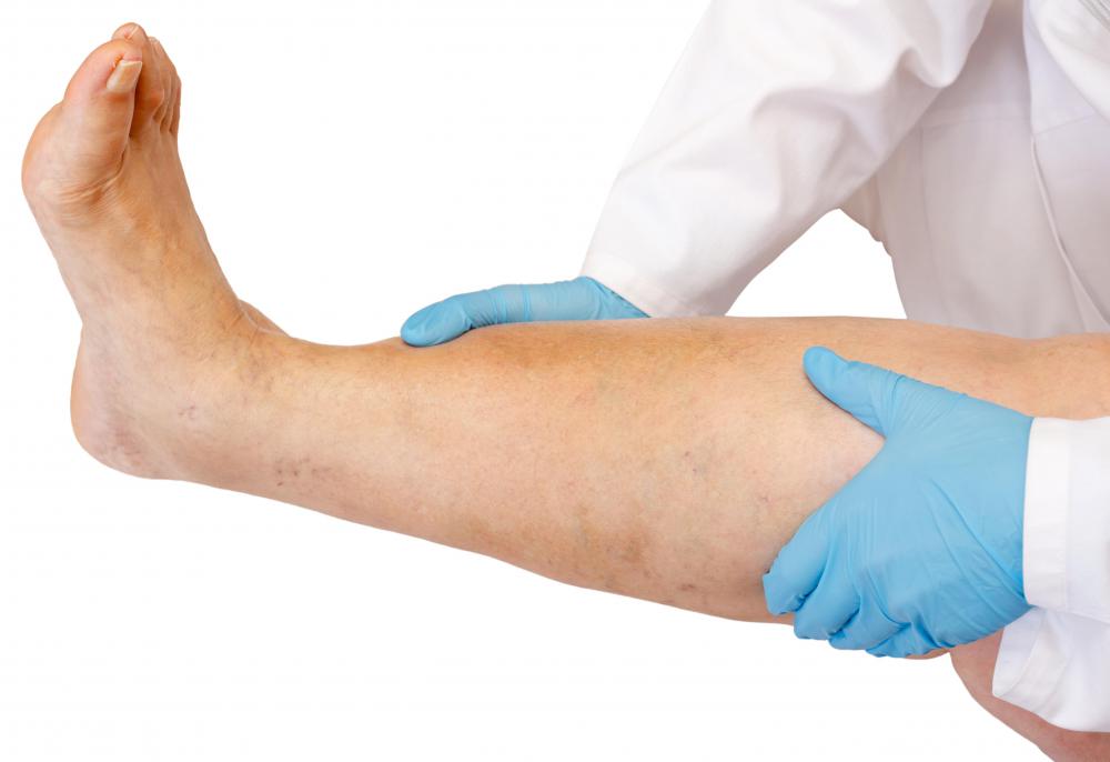 Blood clots usually form in the veins of the legs and can cause a medical condition known as deep vein thrombosis.