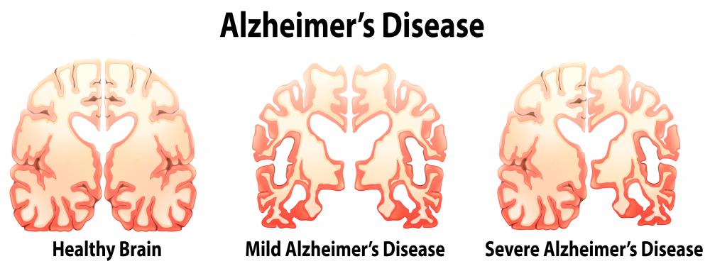 There is often damage to the hippocampus in brains that suffer from Alzheimer's disease.