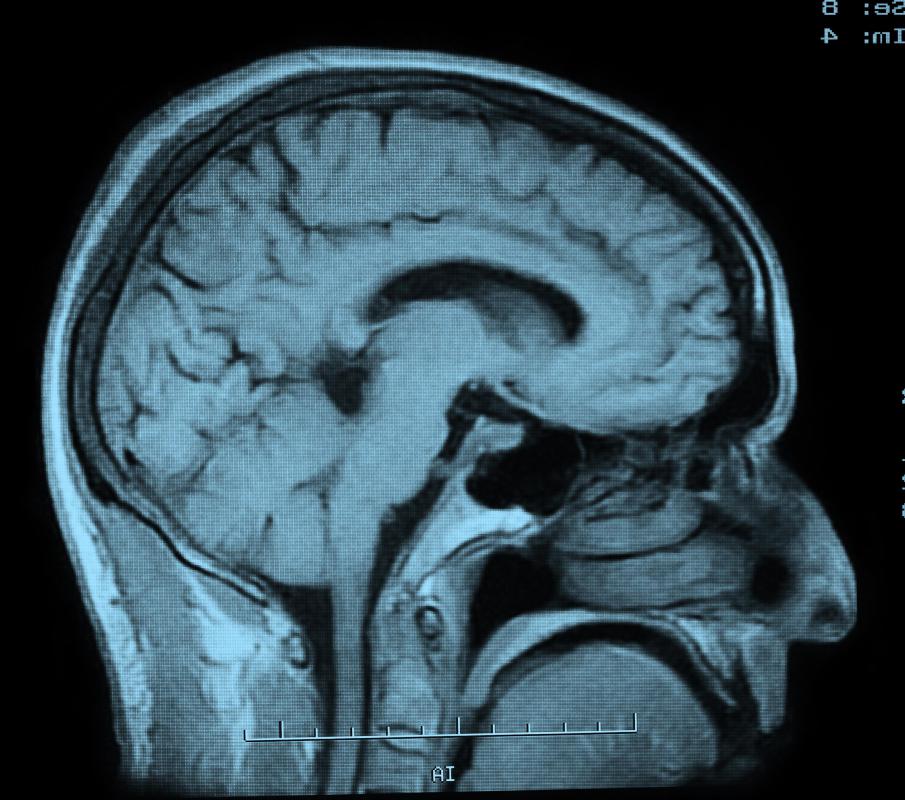 A CT scan can be used to determine the amount of damage done to the brain by an embolism.