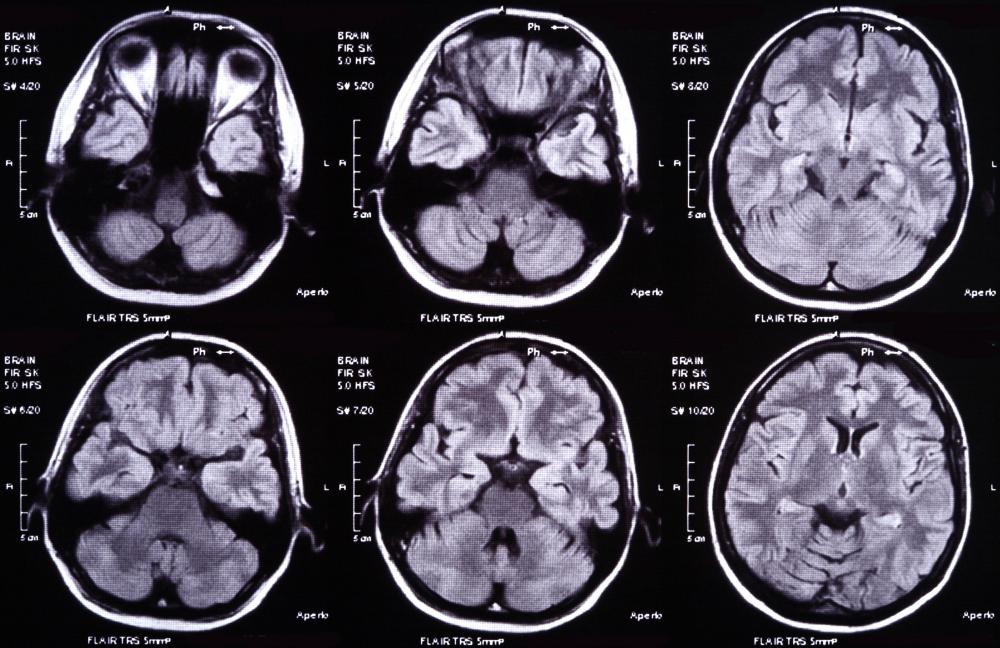 A brain injury can lead to aggression.