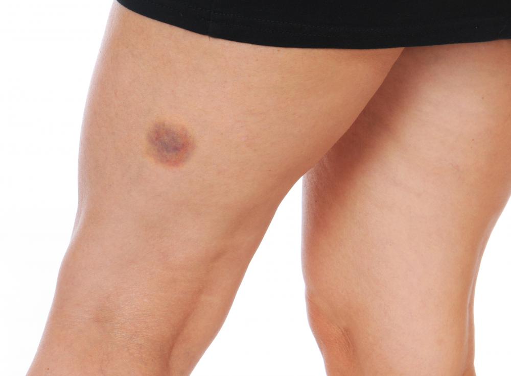 Random leg bruises may be a sign of poor circulation in the legs.