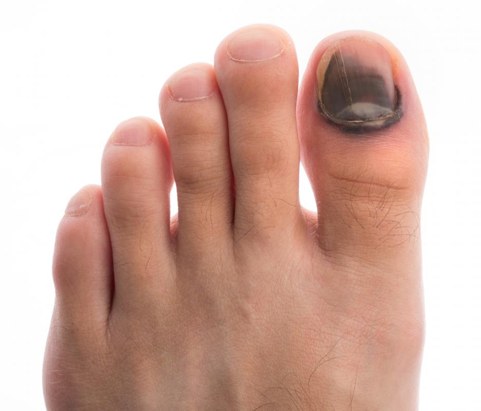 Black toenails are due to trauma to the toe.