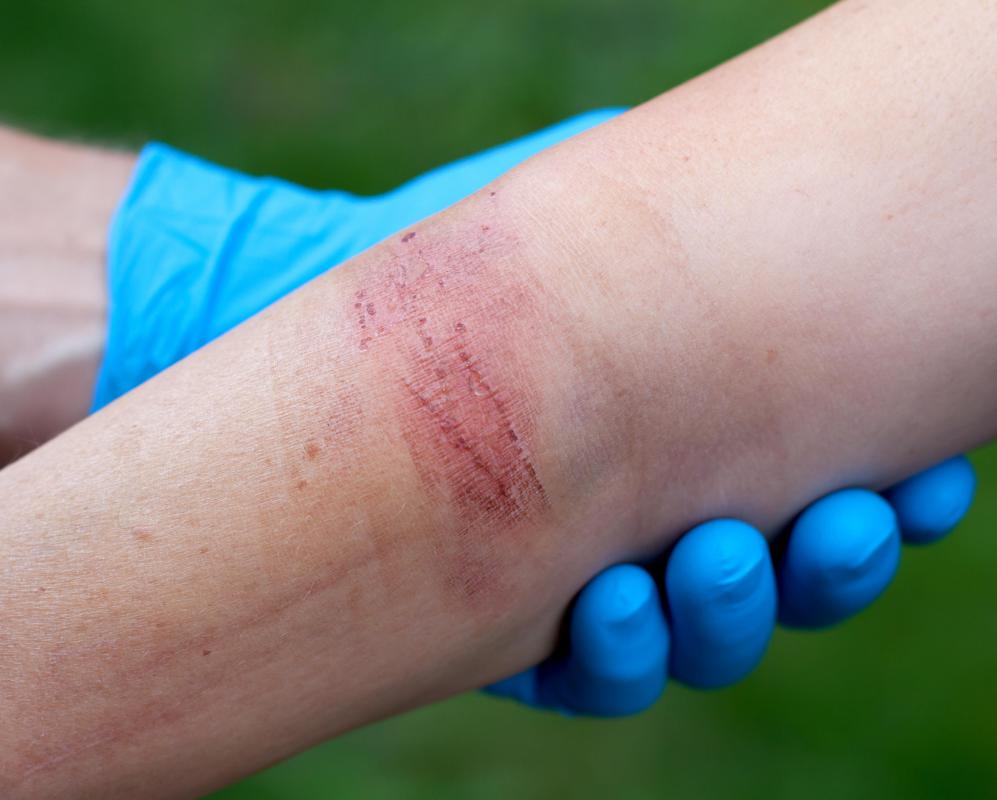 Antibacterial cream may be used to treat burns.