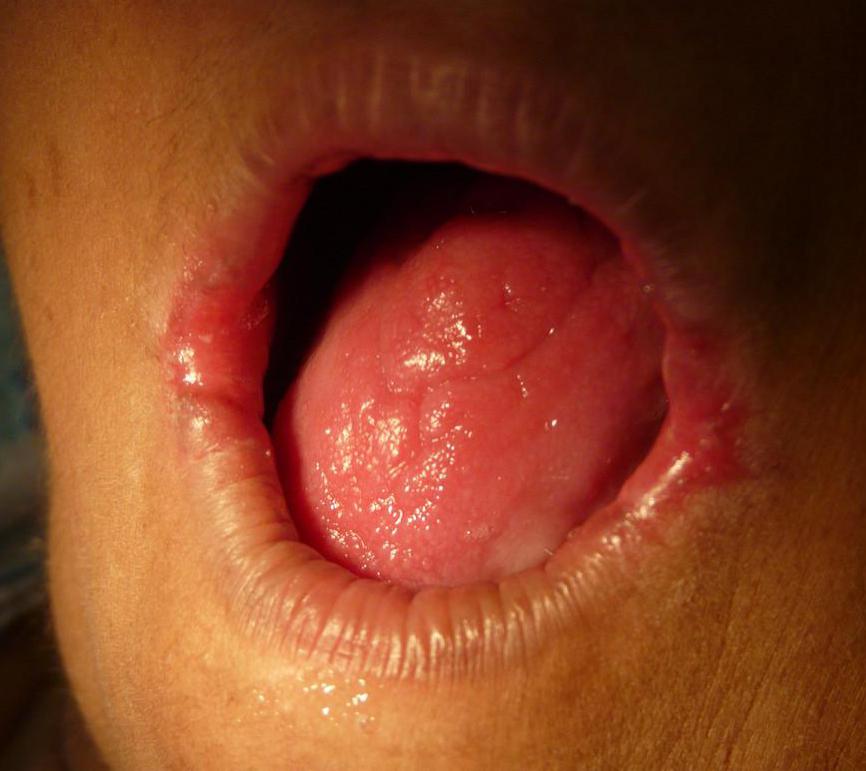 Discoid lesions on the scalp may lead to ulcerous lesions inside the mouth.