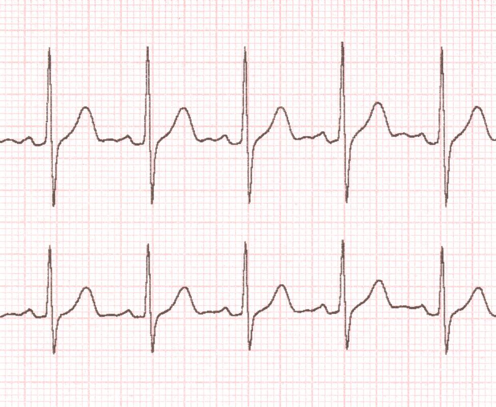 The ECG output shows the rhythm of the electrical impulses inside the heart.