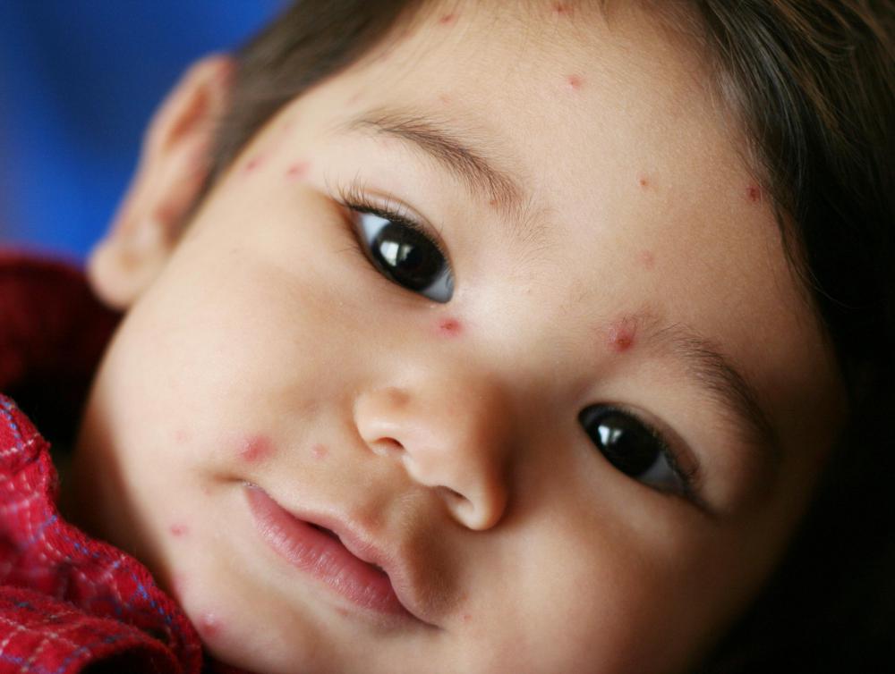 Chickenpox is a common airborne disease.