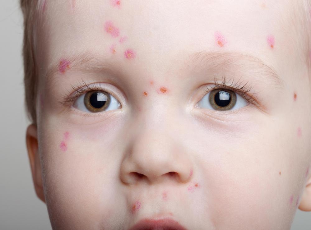 Chicken pox can be the cause of a petechial rash on other parts of the body.