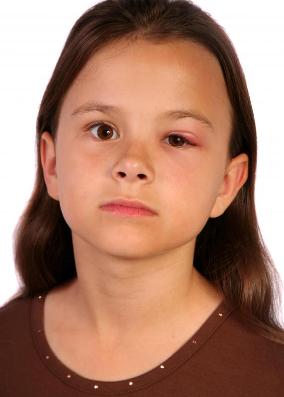 Antibiotic eye drops can be used to treat bacterial conjunctivitis.