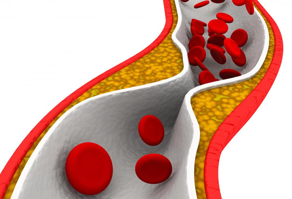 The SMA rarely develops cholesterol plaque.