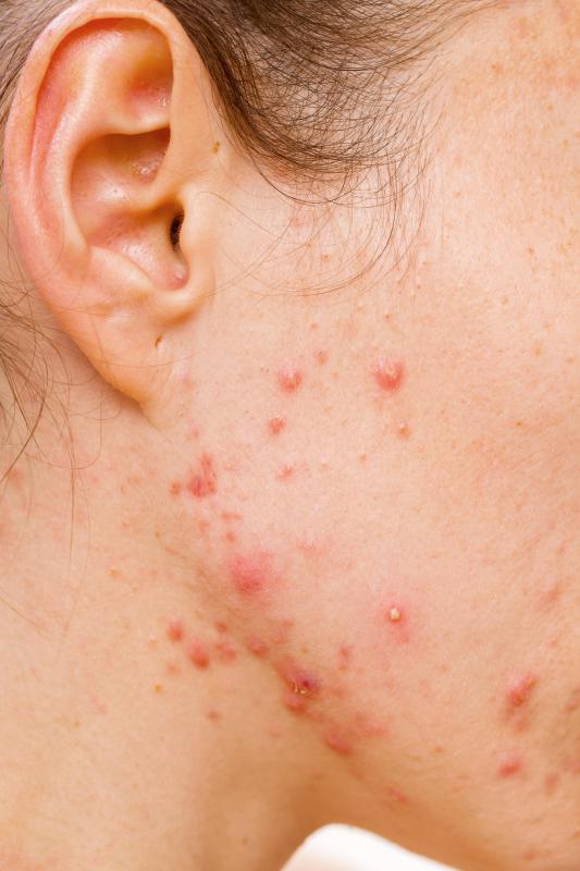 Doxycycline may be prescribed to treat acne.