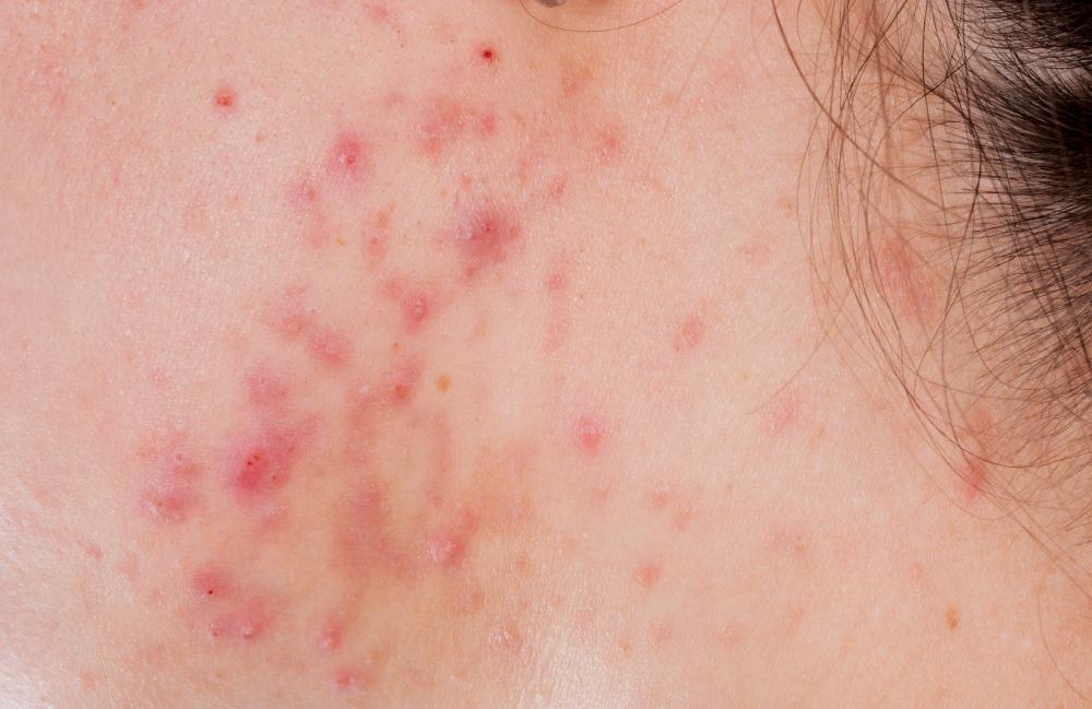 Doxycycline can be used to treat acne.