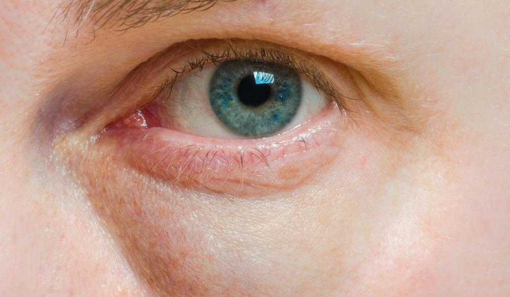 Lack of sleep and stress can cause puffiness, dark circles and eye twitching.
