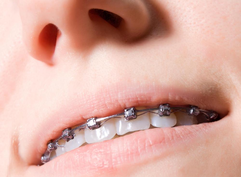 Malocclusions may be treated with braces.