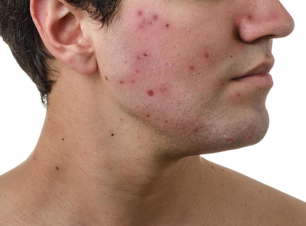 Side effects of DHEA may include acne.
