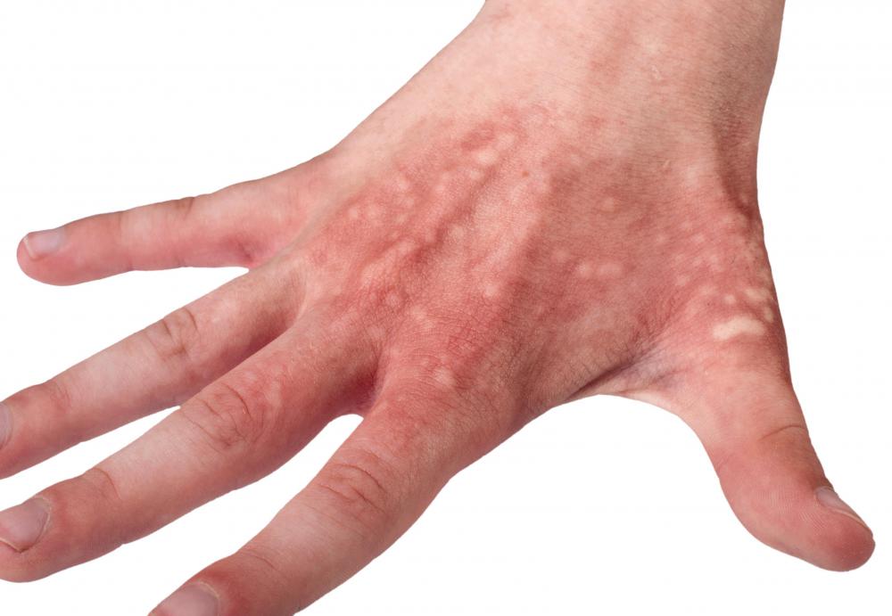 Blisters may be treated with cantharis.