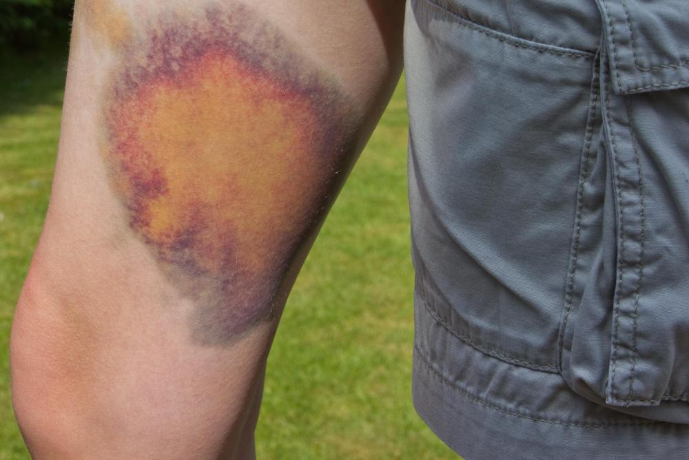Problems associated with fluid buildup in the peritoneal cavity may include bruising and swelling of the legs.
