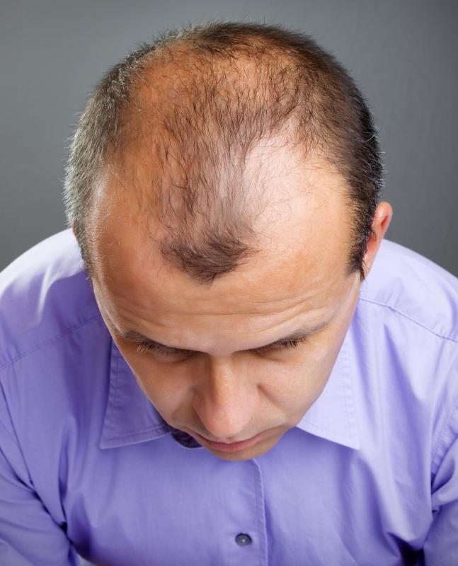 Male pattern baldness may be a side effect of Dianabol.