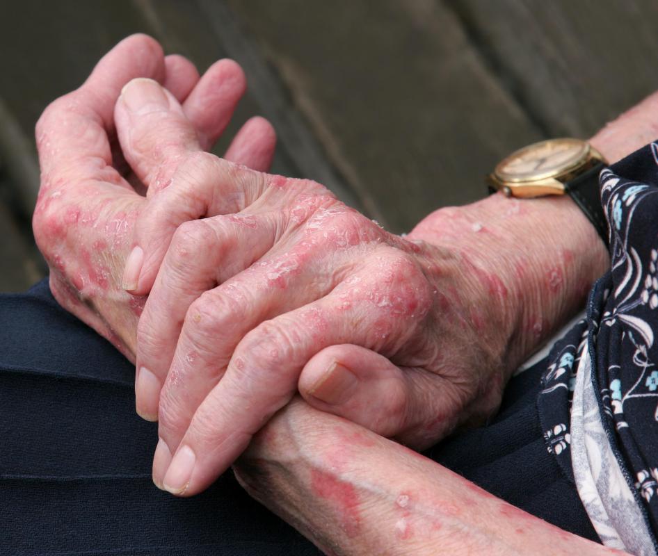 Antihistamines can be used to counteract an allergic reaction to poison ivy.