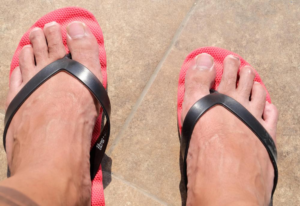 Symptoms of toe cellulitis may include redness or inflammation and pain in the area.