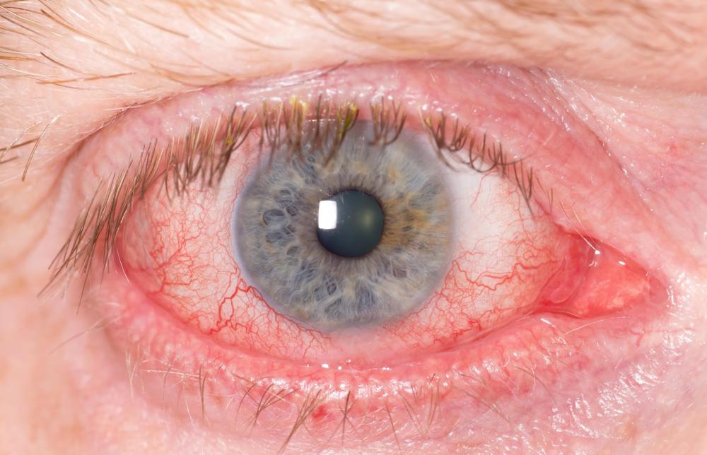 A deficiency in riboflavin may cause bloodshot eyes.