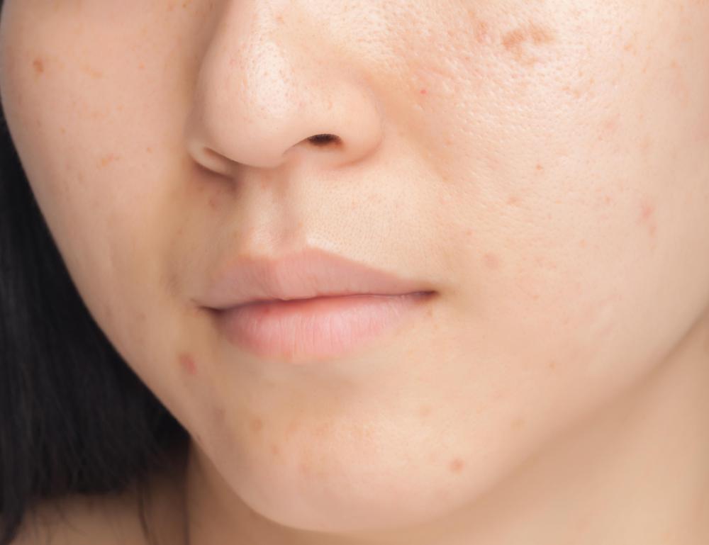 The nutrients in papaya may help reduce the appearance of acne.