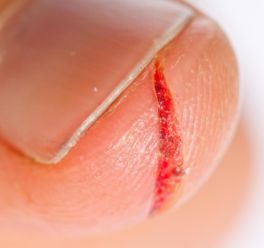 An infection can lead to sepsis.