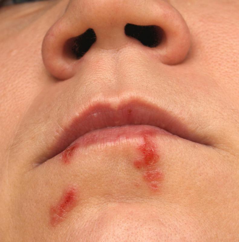 Picking at the scab on a cold sore increases the chance of spreading the infection and of scarring.