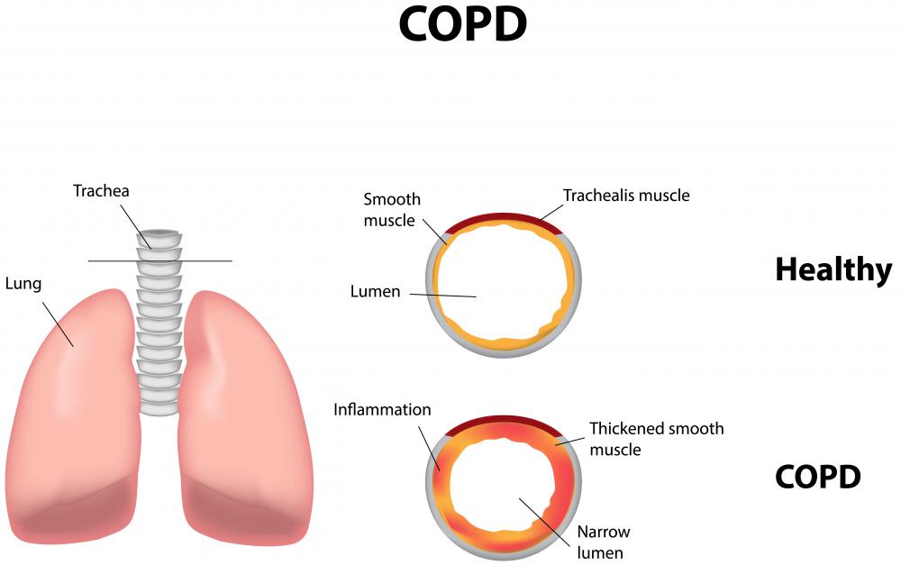 Right atrial enlargement may be associated with chronic obstructive pulmonary disease.