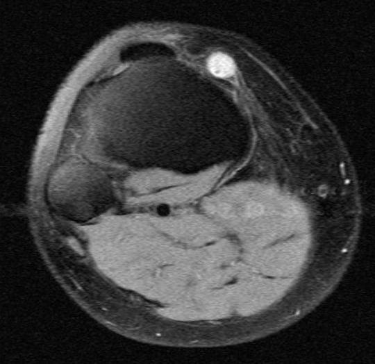 A cross-section of a ganglion cyst.