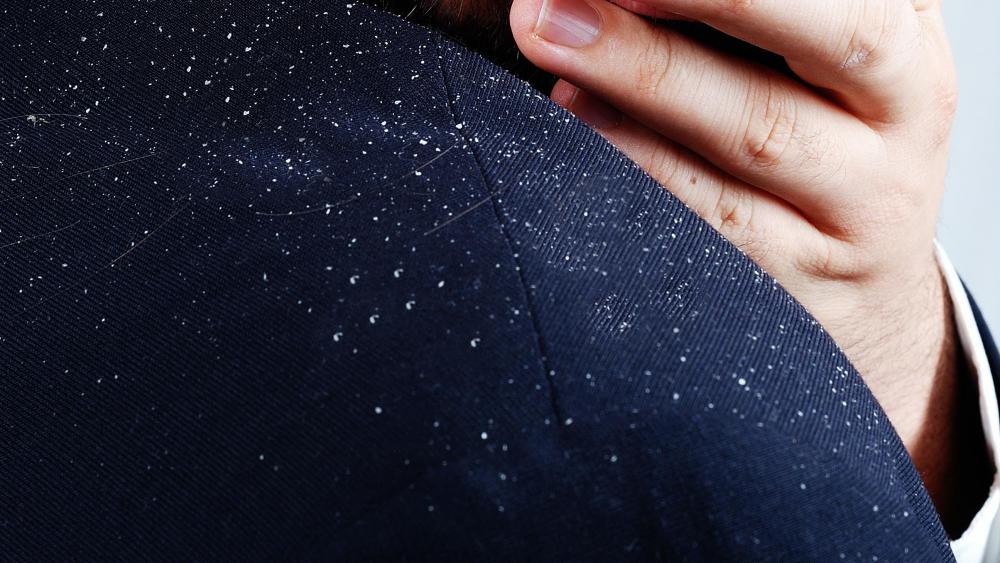 Excessive dandruff can signal a dry scalp.