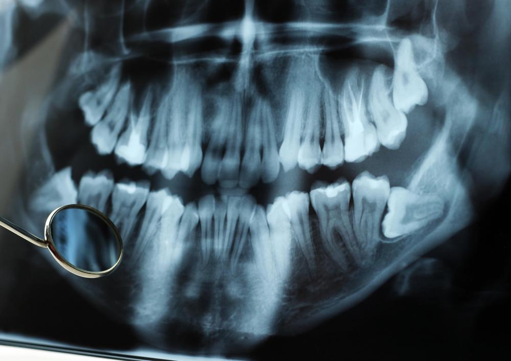 Maxillofacial surgery is often used to remove wisdom teeth which are positioned at awkward angles.