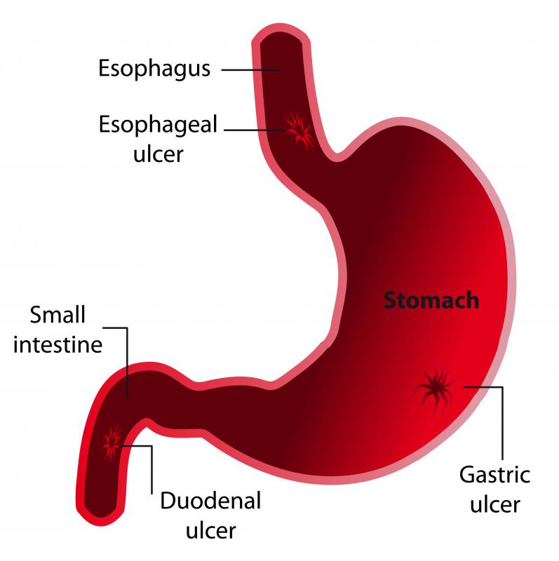Cayenne pepper tea has been used to treat ulcers.